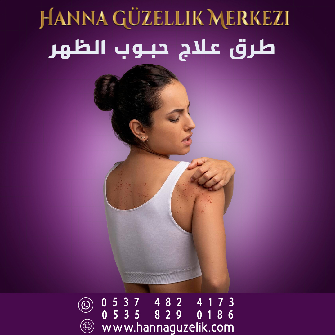 طرق علاج حبوب الظهر