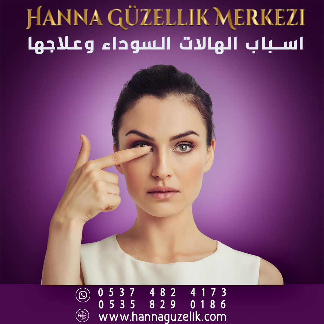 اسباب الهالات السوداء وعلاجها