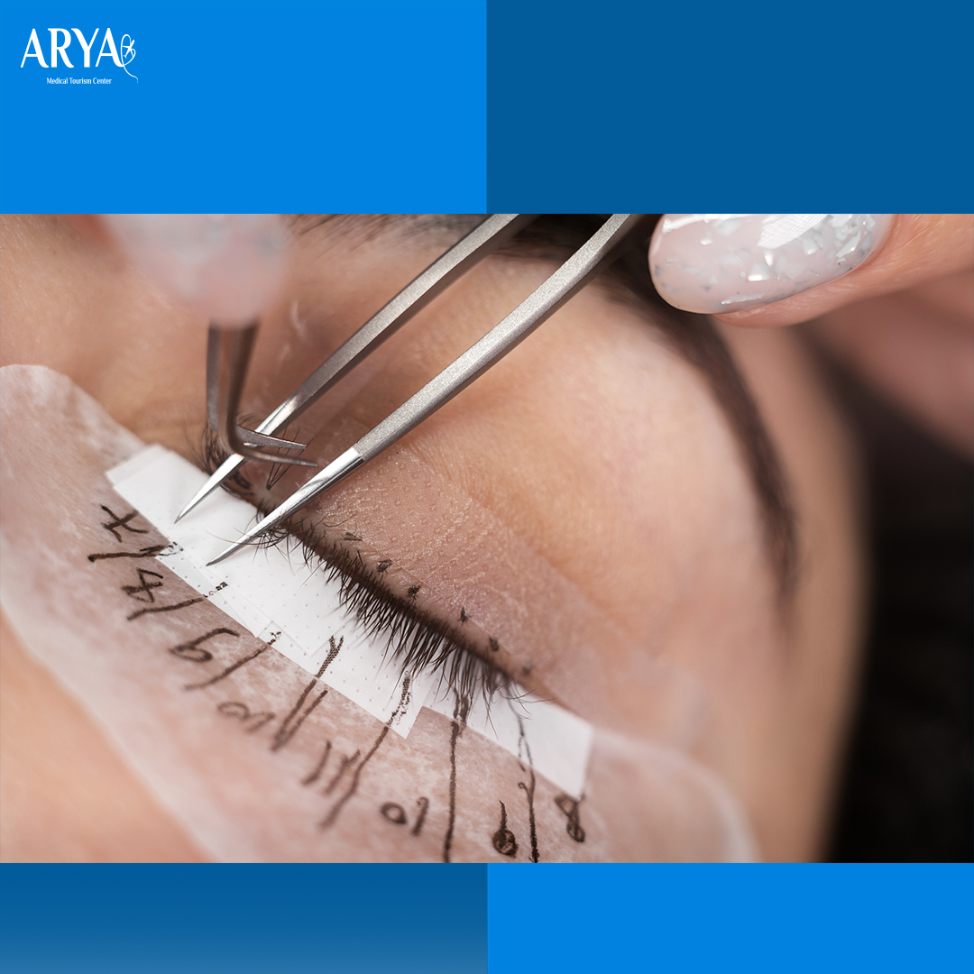 Eyelash Transplant